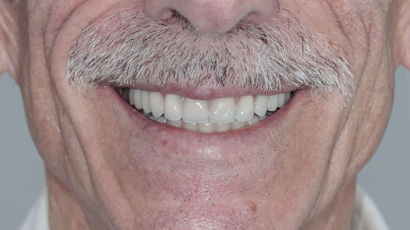 Natural-looking result after All-on-4 full-arch rehabilitation, 3-year follow-up