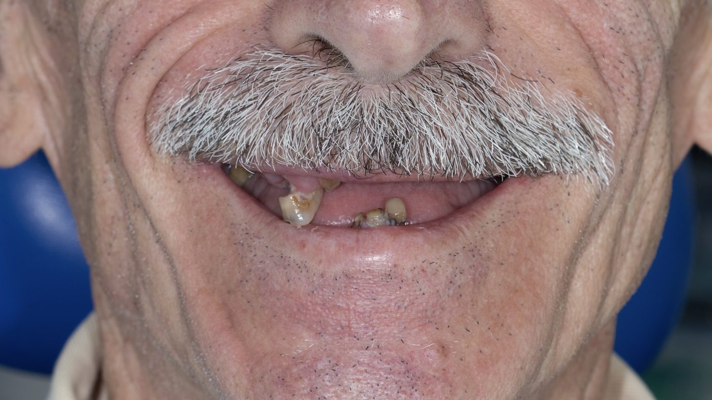 Severely compromised residual dentition prior to All-on-4 full-arch rehabilitation
