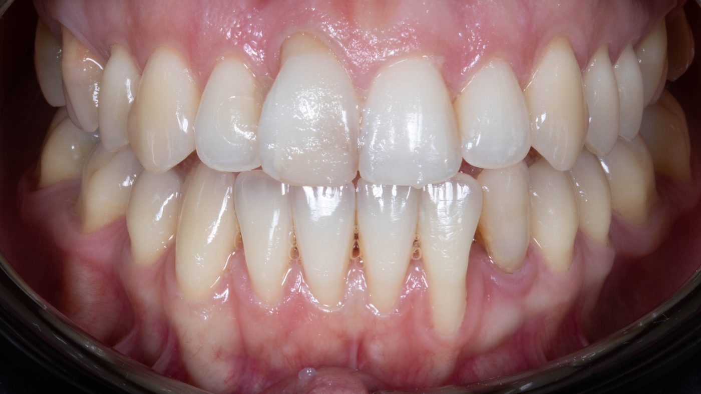 Gingival recession, Miller Class III / Cairo RT2, prior to root coverage surgery