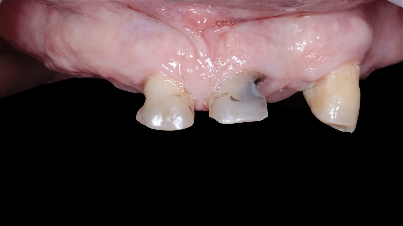 Fractured and worn residual maxillary dentition prior to Full-Arch FP1 rehabilitation