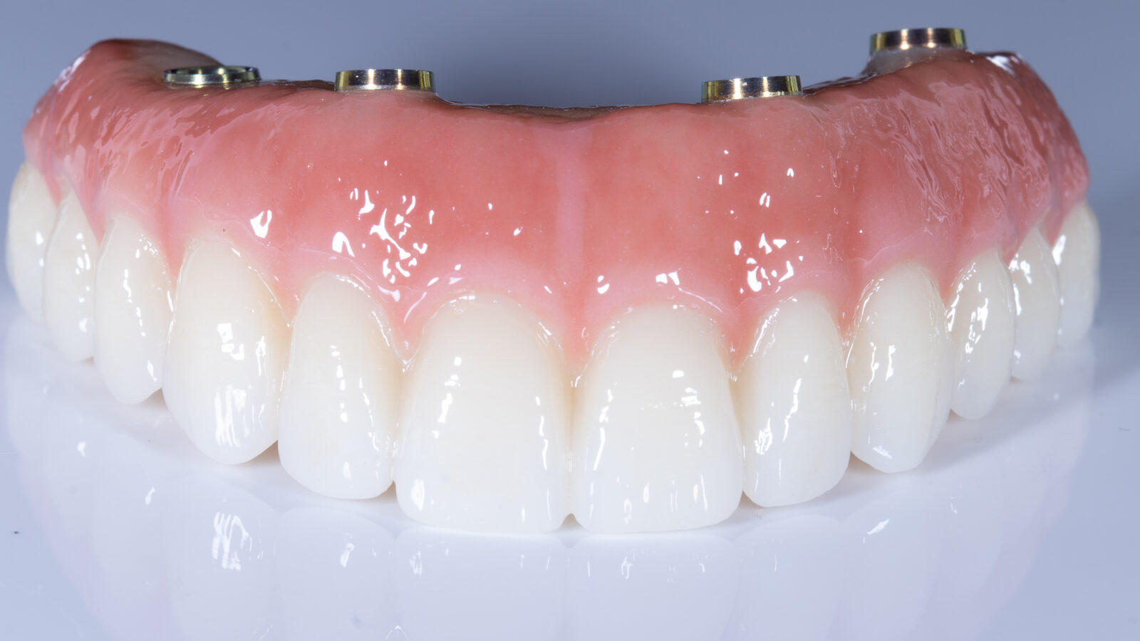 FP3 full-arch fixed prosthesis, replacing teeth and lost gingival contour with a pink component